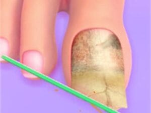 Image of a close-up animated toe with a large, discolored toenail being filed with a green nail file, set against a purple background.